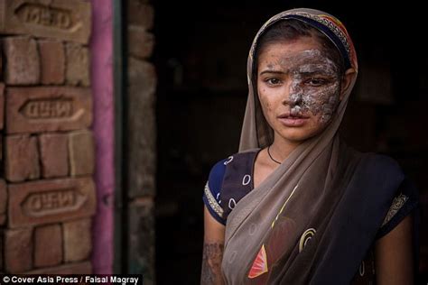 Khushboo Devi Has Acid Thrown In Face By Her Own Father Daily Mail Online