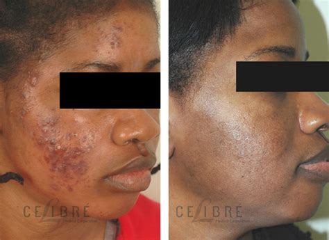 Acne Scars Laser Removal Treatment Before After Pictures 1
