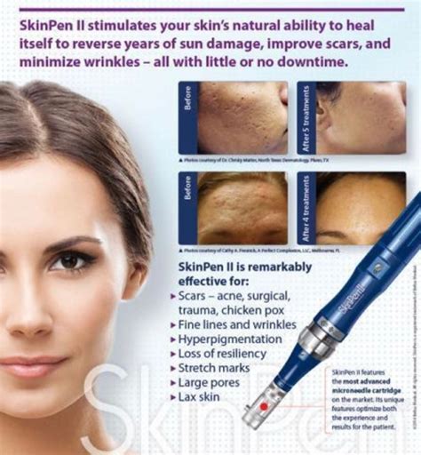 Skinpen Microneedling Skin Rejuvenation In Pittsfield Ma Silver