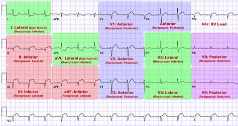 Also, it can distinguish clinically different types of myocardial infarction. ST Elevation MI (STEMI) - Cardio Guide