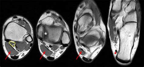 Mri with hardware in foot? Accessory Muscles of the Ankle - Radsource