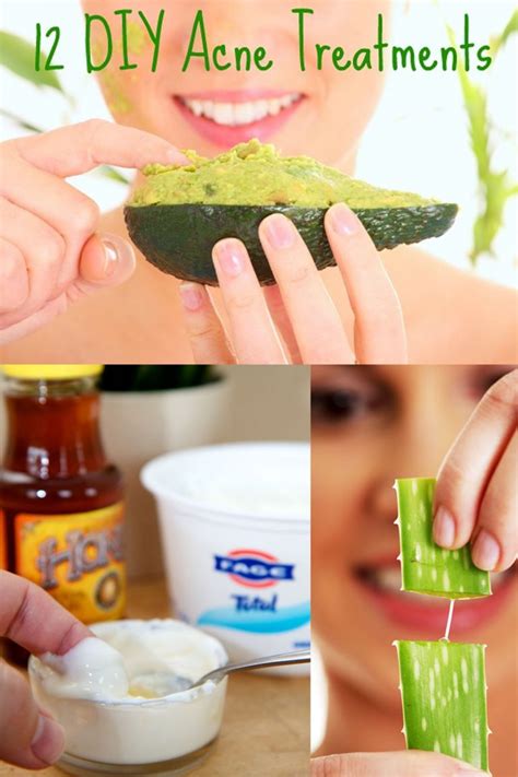 12 Diy Acne Treatments That Will Save Both Your Money And Your Skin