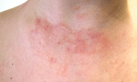 Dermatite atópica em adultos fotos sintomas e tratamento