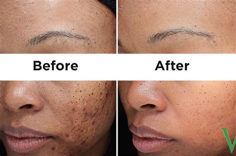 Laser Treatment For Dark Spots On Face Lasers Thekliniceg Dr Mounir William