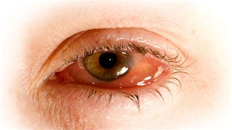 Conjuntivitis Causas Y Prevención Pink Eyes Homeopathy Conjunctivitis