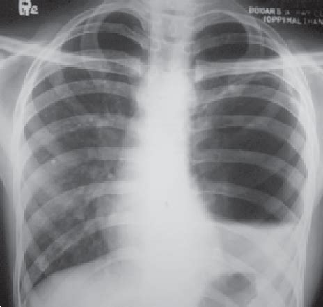 Chest X Ray Showed The Intercostal Tube Occupying A Cyst In A Rounded