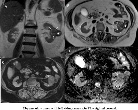 A Rare Complication Of Microwave Ablation For Renal Cell Carcinoma