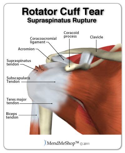 This inflammation to the tendons in shoulder impingement syndrome is a condition where rotator cuff tendons of the shoulders are. A rotator cuff tear can occur in any of the 4 tendons of ...