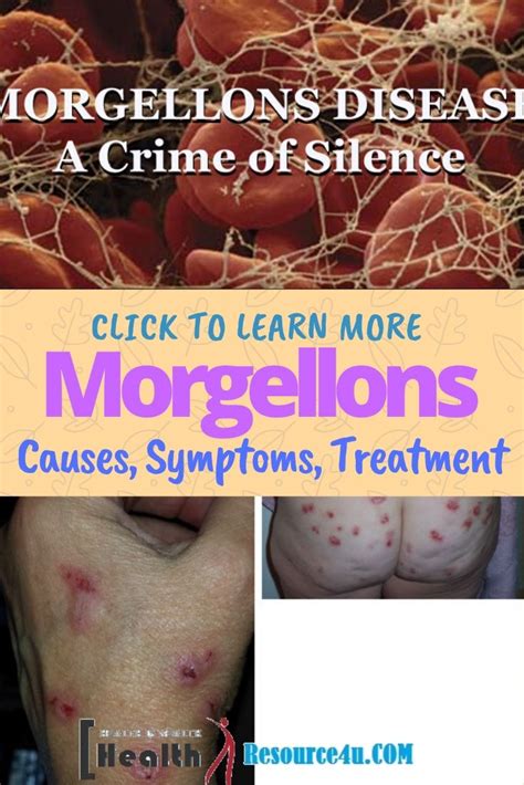 Morgellons Disease Causes Picture Symptoms And Treatment