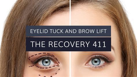 Eyelid Tuck And Brow Lift The Recovery 411 Jason Martin M D