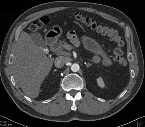 Calcified Adrenal Glands Due To Prior Granulomatous Disease Adrenal
