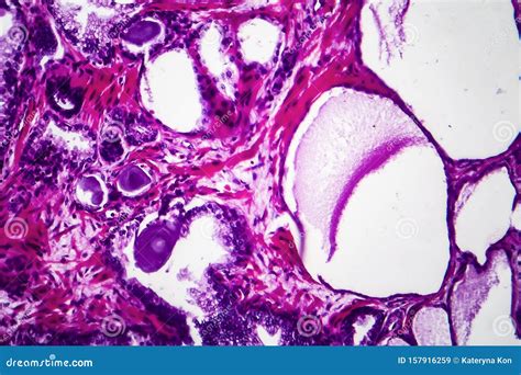 Hiperplasia Prostática Benigna Imagem de Stock Imagem de histologia pilha