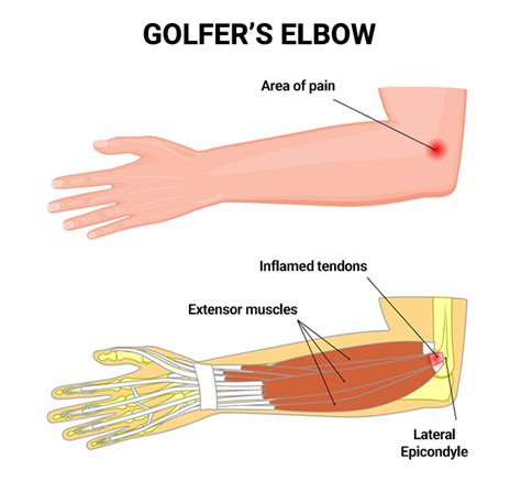 Elbow Pain Treatment Nyc Physical Therapists Nyc