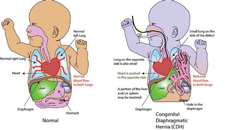 Congenital Diaphragmatic Hernia Cdh Research Duke Department Of
