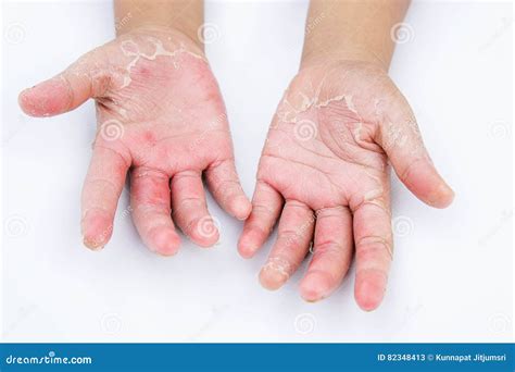 The Dry Hands Peel Contact Dermatitis Fungal Infections Skin Inf
