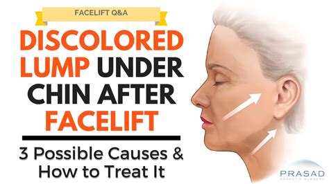 Lump Under The Chin During Facelift Healing Possible Causes And