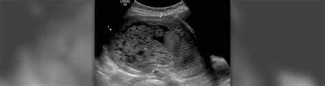Molar Pregnancy Hydatidiform Mole Symptoms And Treatment General