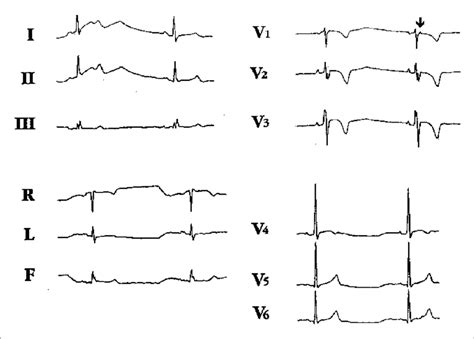 Eletrocardiograma De 12 Derivações