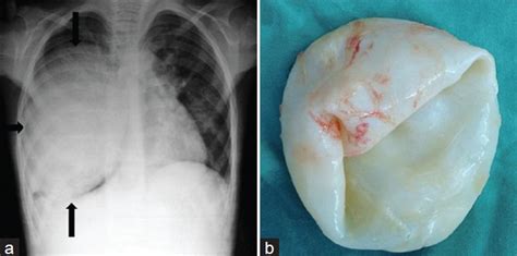 Lung Hydatid Cyst In A 10 Year Old Boy A Chest Radiograph Shows A