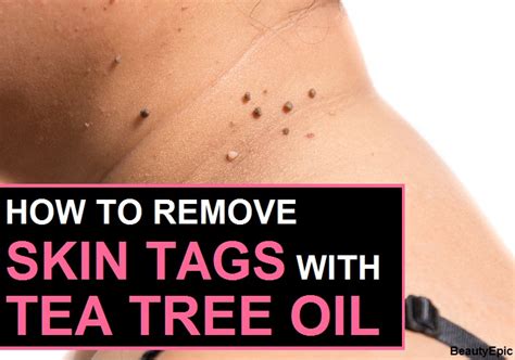 how to remove skin tags with tea tree oil