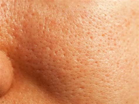 What Causes Orange Peel Skin Uni Cosmetics