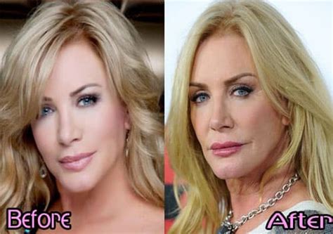 Old Hollywood Plastic Surgery Before And After