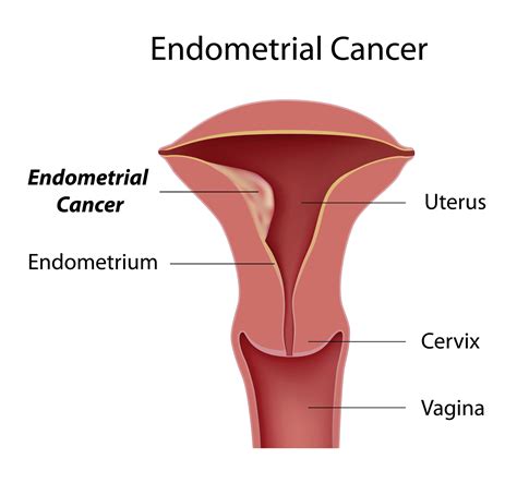 Endometrial Cancer Uterine Cancer Signs Diagnosis And Treatment In