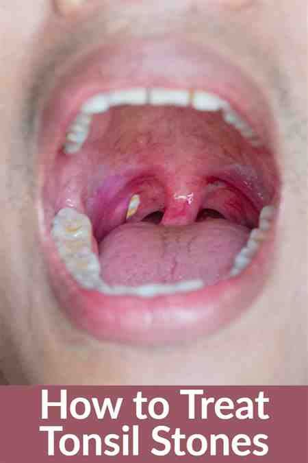Bad Tonsils Cure Voice Sore Deeper Throat Cedag Media Tonsil