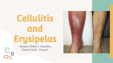 Solution Cellulitis And Erysipelas Differentials Ppt Studypool