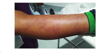 Livedo Racemosa Type Vasculitic Skin Rash In A Dada 2 Patient
