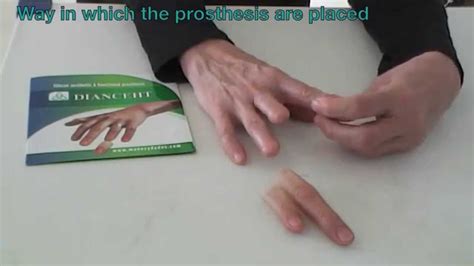 Finger Prosthesis How They Are Placed Removed No 42 YouTube