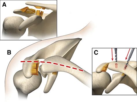 Treatment Of Symptomatic Acromioclavicular Joint Instability By A