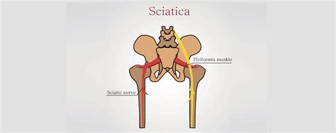 What Causes Sciatica Disorders Health