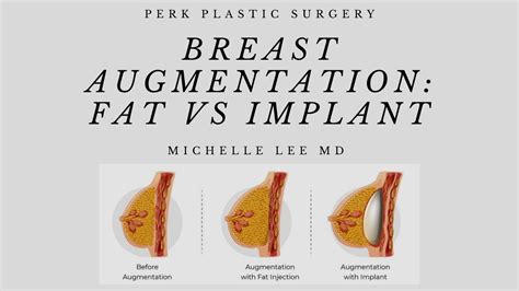 Breast Augmentation Fat Transfer Vs Implants YouTube