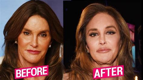 Caitlyn Jenner Unveils Freaky Face Amid Claims Of More Surgery