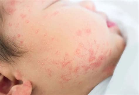 Rash On Infants Face Types Causes And Treatments