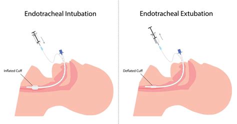 Tracheal Extubation Holistic Doctor Online