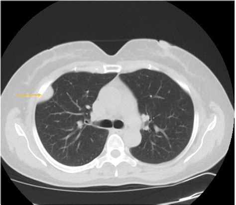 Cureus Solitary Fibrous Tumors Of The Pleura