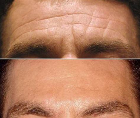 Forehead Frown Glabella Line Anti Wrinkle Treatment