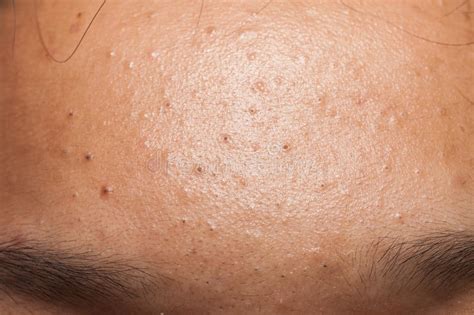 Forehead With Lots Of Blackheads Stock Photo Image Of Beauty Skin