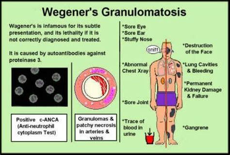 800b282d23b882c7fd412a3f846b6935.jpg 640×434 pixels | Vasculitis