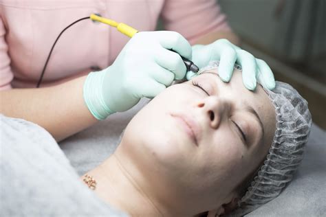 The Benefits Of Electrolysis Hair Removal