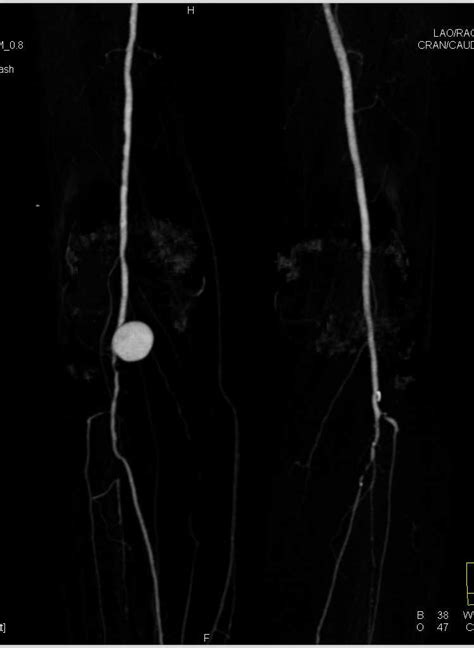 Popliteal Artery Aneurysm On Dual Energy Cta Musculoskeletal Case
