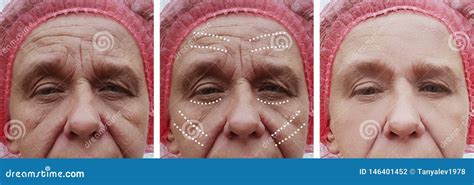 Elderly Woman`s Wrinkles Face Before And After Problemcorrection