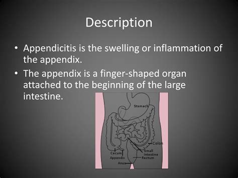 Ppt Appendicitis Powerpoint Presentation Free Download Id4175359