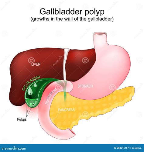 Cross Section Of A Gallbladder With Polyps Stock Vector Illustration