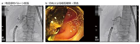 胆管結石治療困難例に対する工夫 新規透視装置の特徴 岩崎 ...