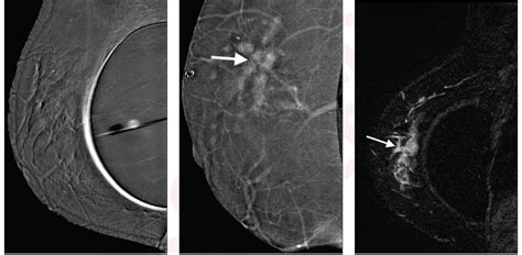 Contrast Enhanced Mammography For Breast Cancer In Women With Augmented