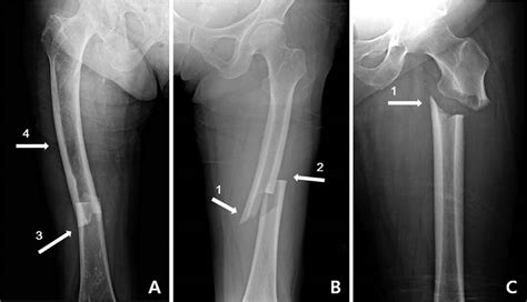 Broken Femur Types Causes Treatment Recovery Time And Complications
