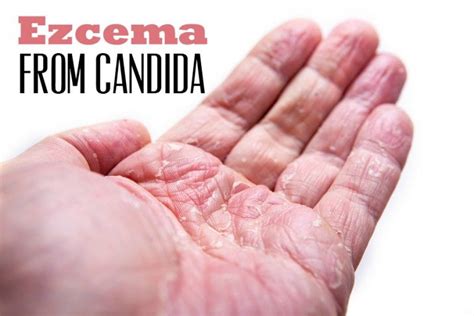 Ezcema From Candida Yeast Infection Causes Candida Overgrowth